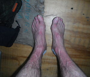 Photo of legs from the knees down looking very red and sore