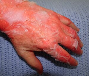 A hand with a simulated kitchen burn.