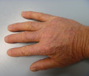 A man's hand with dry skin