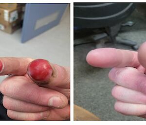 Before and after shots of a man's thumb and forefinger affected by frostbite. In the first photo the tips are very red and blistered. In the second photo they are completely healed up.