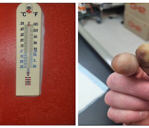 A thermometer showing -30 degrees celcius and a picture of a man's thumb and forefinger showing black and white areas from frostbite.