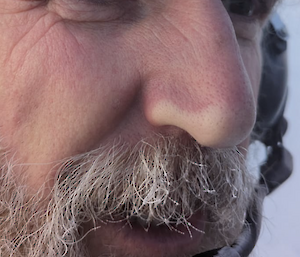 Close-up view of a man's face showing the whitened tip of his nose.